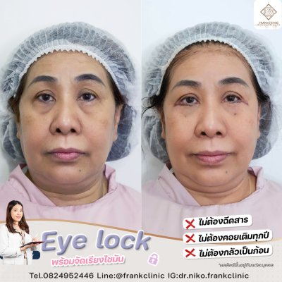 รีวิว เทคนิค EYELOCK ตัดถุงใต้ตา