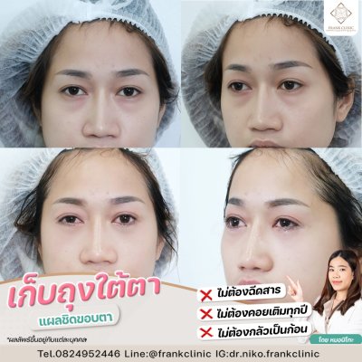 รีวิว ตัดถุงใต้ตา