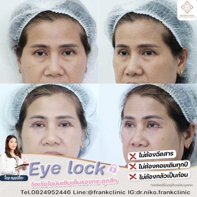 รีวิว เทคนิค EYELOCK ตัดถุงใต้ตา