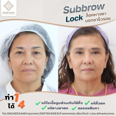 รีวิว ยกคิ้ว เทคนิค SUBBROWLOCK