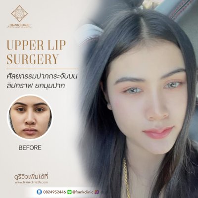 รีวิว ศัลยกรรม ปากกระจับ 2 (Lip surgery)