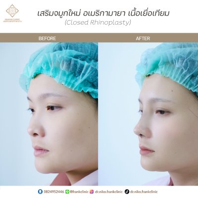 รีวิว เสริมจมูก (Rhinoplasty)