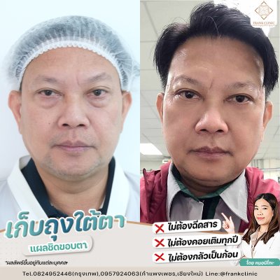 รีวิว ตัดถุงใต้ตา