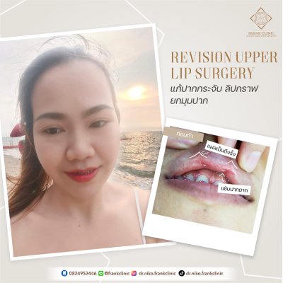 รีวิว ศัลยกรรม ปากกระจับ 2 (Lip surgery)