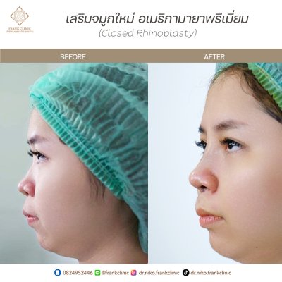 รีวิว เสริมจมูก (Rhinoplasty)