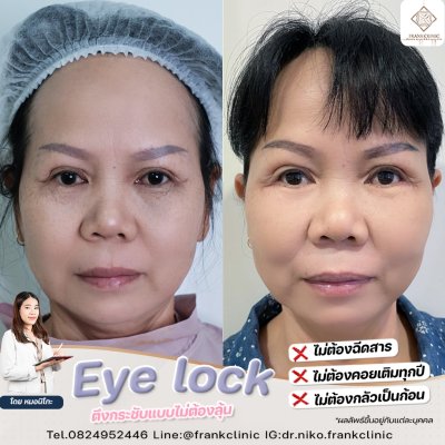 รีวิว เทคนิค EYELOCK ตัดถุงใต้ตา