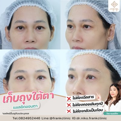 รีวิว ตัดถุงใต้ตา