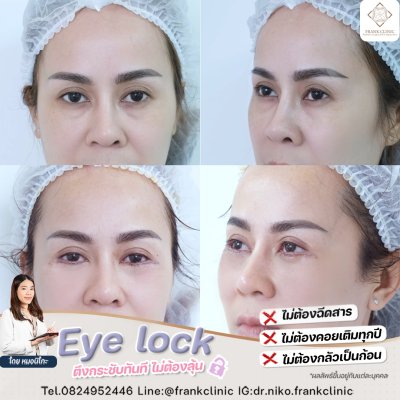 รีวิว เทคนิค EYELOCK ตัดถุงใต้ตา