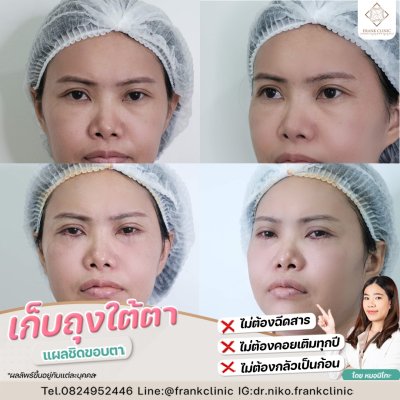 รีวิว ตัดถุงใต้ตา