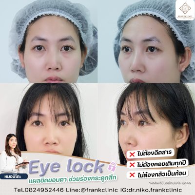 รีวิว เทคนิค EYELOCK ตัดถุงใต้ตา