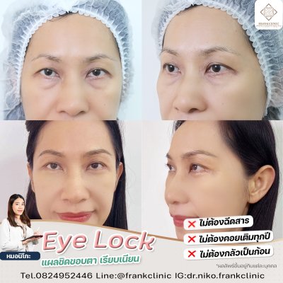 รีวิว เทคนิค EYELOCK ตัดถุงใต้ตา