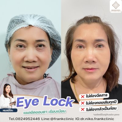 รีวิว เทคนิค EYELOCK ตัดถุงใต้ตา