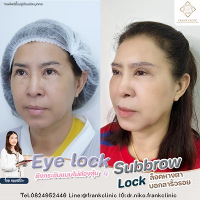 รีวิว ยกคิ้ว เทคนิค SUBBROWLOCK