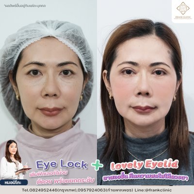 รีวิว เทคนิค EYELOCK ตัดถุงใต้ตา