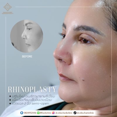 รีวิว เสริมจมูก (Rhinoplasty)