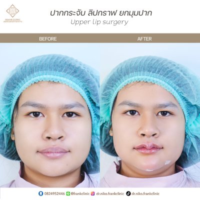 รีวิว ศัลยกรรม ปากกระจับ 2 (Lip surgery)