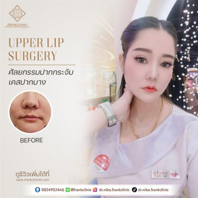 รีวิว ศัลยกรรม ปากกระจับ 2 (Lip surgery)