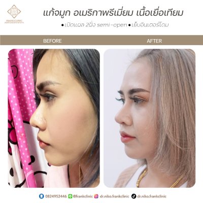 รีวิว เสริมจมูก (Rhinoplasty)