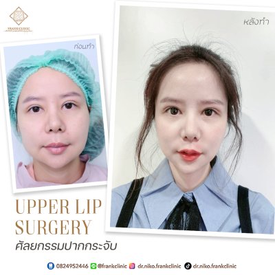 รีวิว ศัลยกรรม ปากกระจับ 2 (Lip surgery)