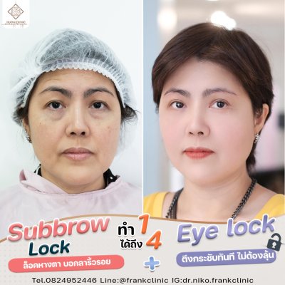 รีวิว เทคนิค EYELOCK ตัดถุงใต้ตา