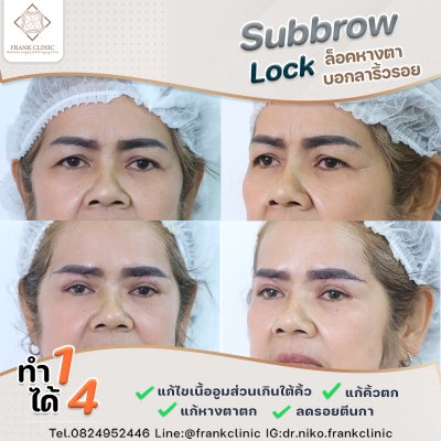 รีวิว ยกคิ้ว เทคนิค SUBBROWLOCK