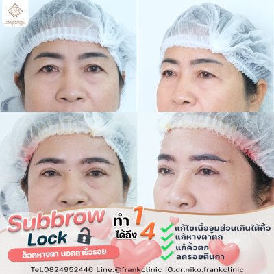 รีวิว ยกคิ้ว เทคนิค SUBBROWLOCK