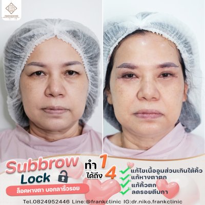 รีวิว ยกคิ้ว เทคนิค SUBBROWLOCK