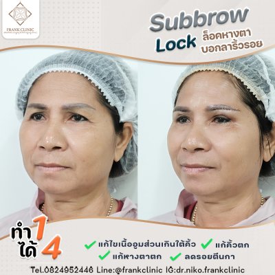 รีวิว ยกคิ้ว เทคนิค SUBBROWLOCK