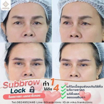 รีวิว ยกคิ้ว เทคนิค SUBBROWLOCK