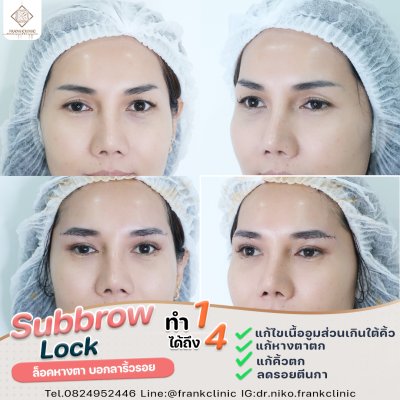 รีวิว ยกคิ้ว เทคนิค SUBBROWLOCK