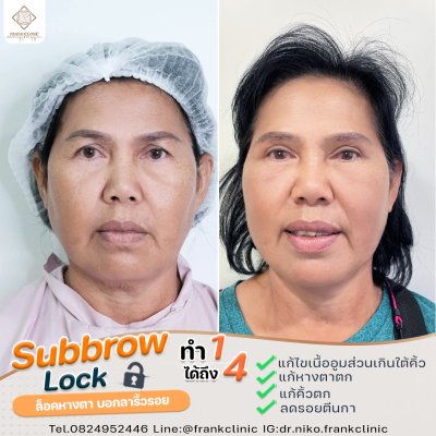 รีวิว ยกคิ้ว เทคนิค SUBBROWLOCK