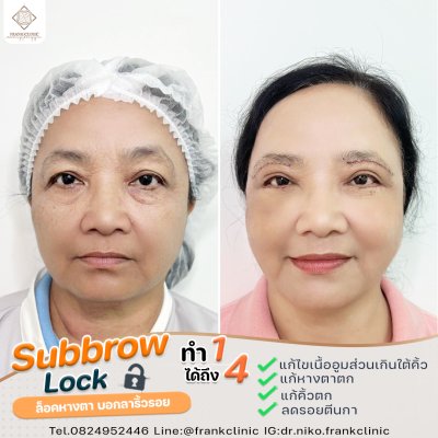 รีวิว ยกคิ้ว เทคนิค SUBBROWLOCK