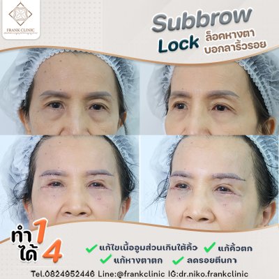 รีวิว ยกคิ้ว เทคนิค SUBBROWLOCK