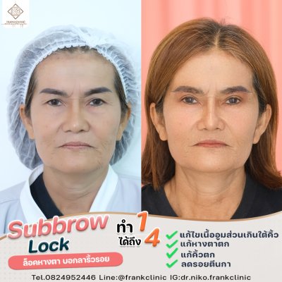 รีวิว ยกคิ้ว เทคนิค SUBBROWLOCK