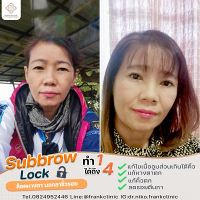 รีวิว ยกคิ้ว เทคนิค SUBBROWLOCK