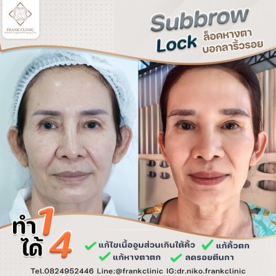 รีวิว ยกคิ้ว เทคนิค SUBBROWLOCK