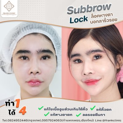 รีวิว ยกคิ้ว เทคนิค SUBBROWLOCK