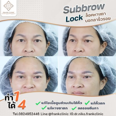 รีวิว ยกคิ้ว เทคนิค SUBBROWLOCK