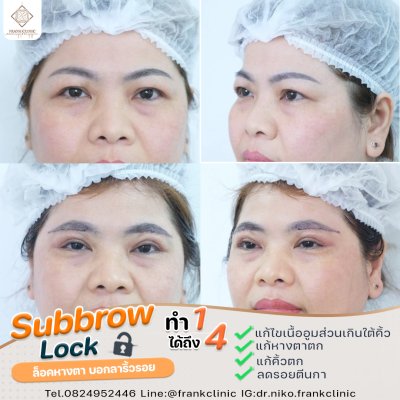 รีวิว ยกคิ้ว เทคนิค SUBBROWLOCK