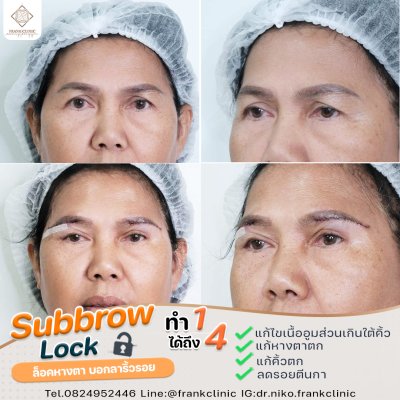 รีวิว ยกคิ้ว เทคนิค SUBBROWLOCK