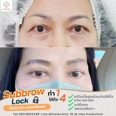 รีวิว ยกคิ้ว เทคนิค SUBBROWLOCK