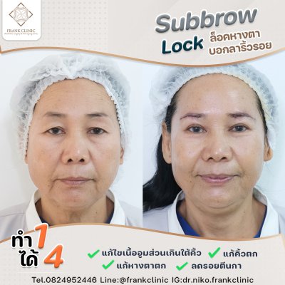 รีวิว ยกคิ้ว เทคนิค SUBBROWLOCK