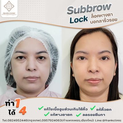 รีวิว ยกคิ้ว เทคนิค SUBBROWLOCK