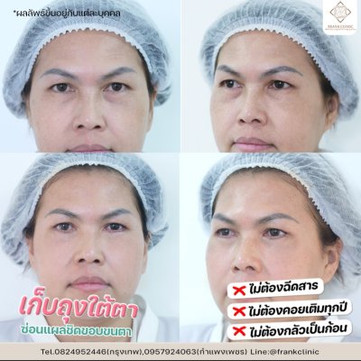 รีวิว ตัดถุงใต้ตา