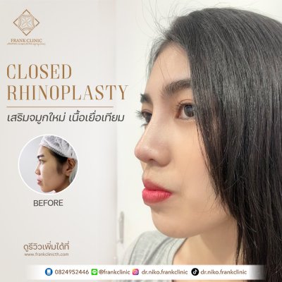 รีวิว เสริมจมูก (Rhinoplasty)