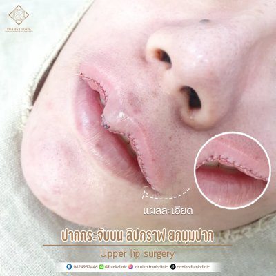 รีวิว ศัลยกรรม ปากกระจับ 2 (Lip surgery)