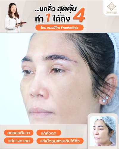 รีวิว ยกคิ้ว เทคนิค SUBBROWLOCK