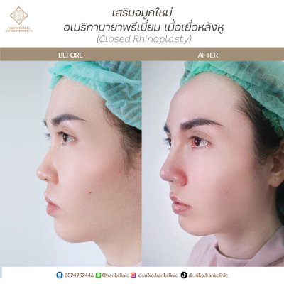 รีวิว เสริมจมูก (Rhinoplasty)