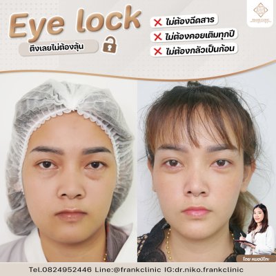 รีวิว เทคนิค EYELOCK ตัดถุงใต้ตา