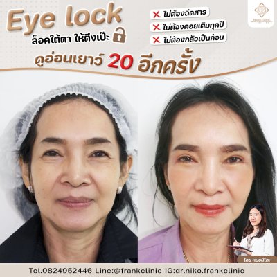 รีวิว เทคนิค EYELOCK ตัดถุงใต้ตา